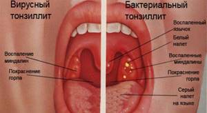 бактериальная ангина симптомы у взрослых лечение