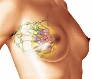 фиброзная мастопатия молочной железы что это симптомы и лечение