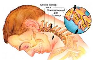 лечение шейного остеохондроза симптомы