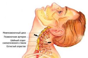 лечение шейного остеохондроза симптомы