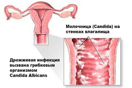 молочница у девушек причины симптомы лечение