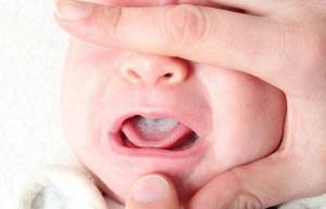 молочница у младенцев во рту лечение симптомы и лечение