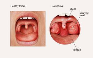 молочница в горле у взрослых симптомы лечение