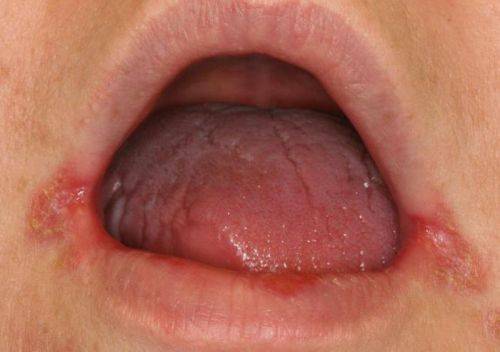 молочница во рту лечение симптомы
