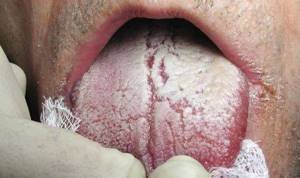 молочница во рту у взрослых симптомы лечение народными