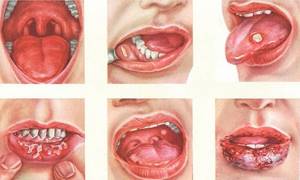 молочница во рту у взрослых симптомы лечение препараты