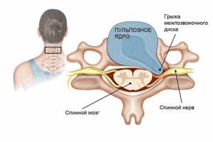 обострение шейного остеохондроза симптомы и способы лечения