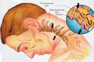 шейно поясничный остеохондроз симптомы и лечение