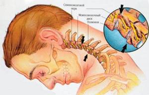 шейный остеохондроз симптомы и лечение йодом