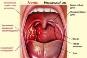 стафилококковая ангина симптомы и лечение