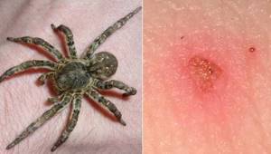 укус паука симптомы у человека лечение народными средствами