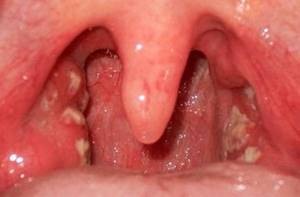 воспаление горла симптомы лечение