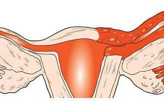 воспаление трубы матки симптомы лечение