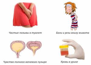 цистит у кормящей матери симптомы и лечение