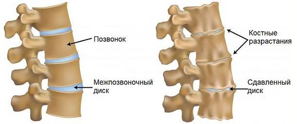 гипертонус мышц шеи у взрослого симптомы и лечение