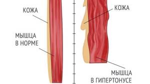 гипертонус шейных мышц у взрослых симптомы и лечение