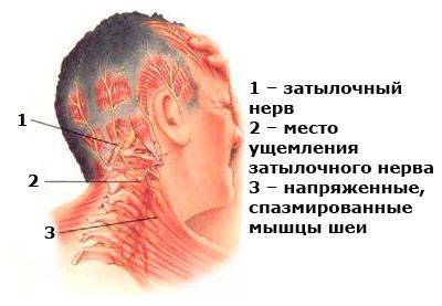 миогелоз шеи симптомы и лечение