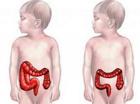 непроходимость кишечника у ребенка симптомы лечение