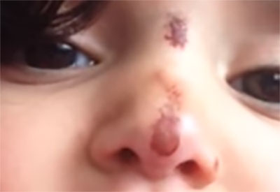 перелом носа у ребенка симптомы лечение