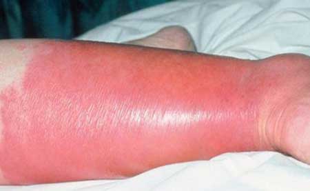 рожистое воспаление голени симптомы и лечение
