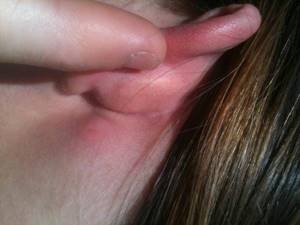 рожистое воспаление уха симптомы и лечение
