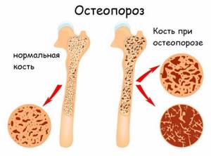 шейный остеопороз симптомы лечение в домашних условиях