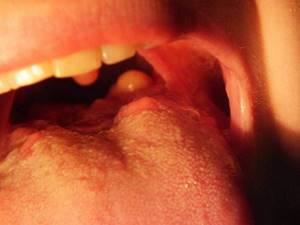 воспаление корня языка симптомы и лечение