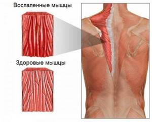 воспаление мышц плеча симптомы и лечение