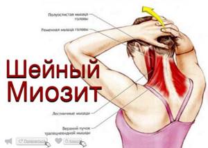 воспаление мышц шеи симптомы и лечение