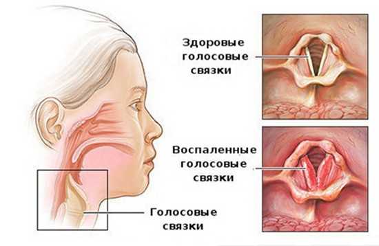 воспаление слизистой оболочки гортани симптомы лечение