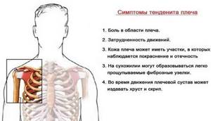 воспаление связок плеча симптомы и лечение