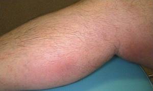 воспаление вены на ноге симптомы лечение
