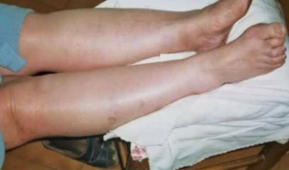воспаление вены на ноге симптомы лечение