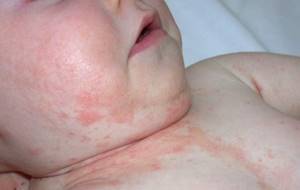 аллергический дерматит у ребенка симптомы и лечение