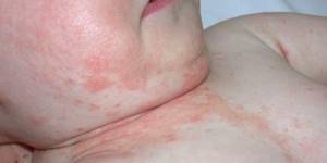 аллергический дерматит у ребенка симптомы и лечение