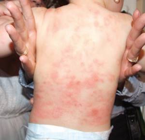 аллергия на глютен у ребенка симптомы лечение