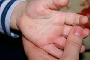 аллергия на ладошках у ребенка причины лечение симптомы