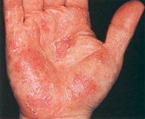 аллергия на ладошках у ребенка причины лечение симптомы