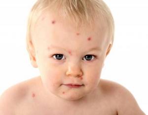 аллергия у грудного ребенка симптомы и лечение