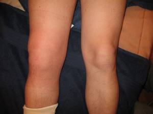 артрит коленного сустава симптомы и лечение у ребенка