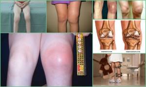артрит коленного сустава симптомы и лечение у ребенка