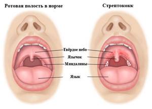 болит горло у ребенка симптомы и лечение