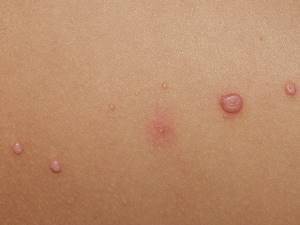 дерматит у грудного ребенка симптомы и лечение