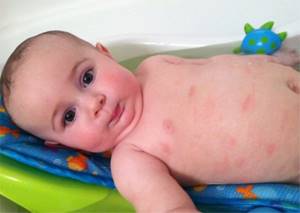 дерматит у ребенка симптомы и лечение комаровский
