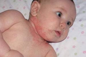 дерматит у ребенка симптомы и лечение комаровский