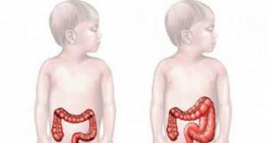 длинный кишечник у ребенка симптомы и лечение