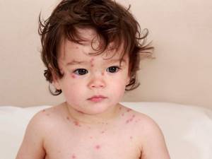 герпес у ребенка 3 года симптомы и лечение