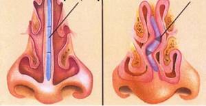 гребень в носу симптомы и лечение