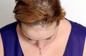 грибок кожи головы у ребенка симптомы и лечение