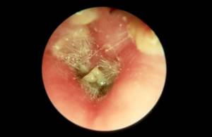 грибок в ушах симптомы лечение у ребенка